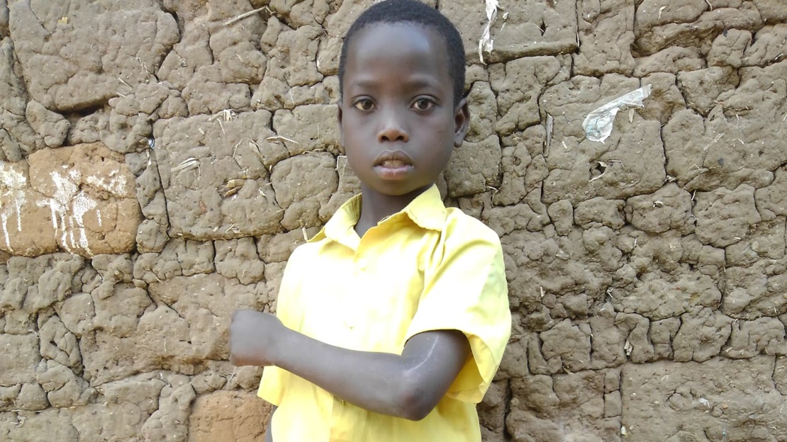 A little boy, Promise, stands and shows the scar from his broken elbow.