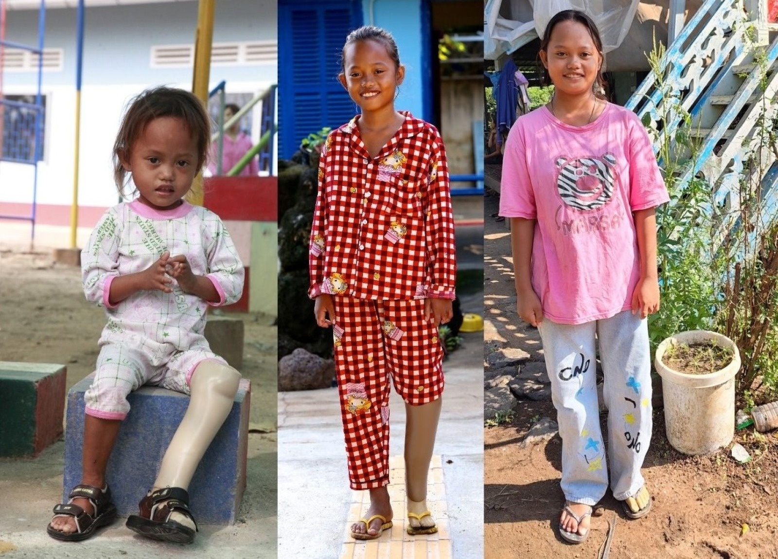 In Channa’s footsteps…12 years of prosthetic support