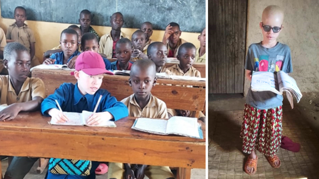 A Rwandan Girl's Journey: Breaking Down Stigma Around Albinism