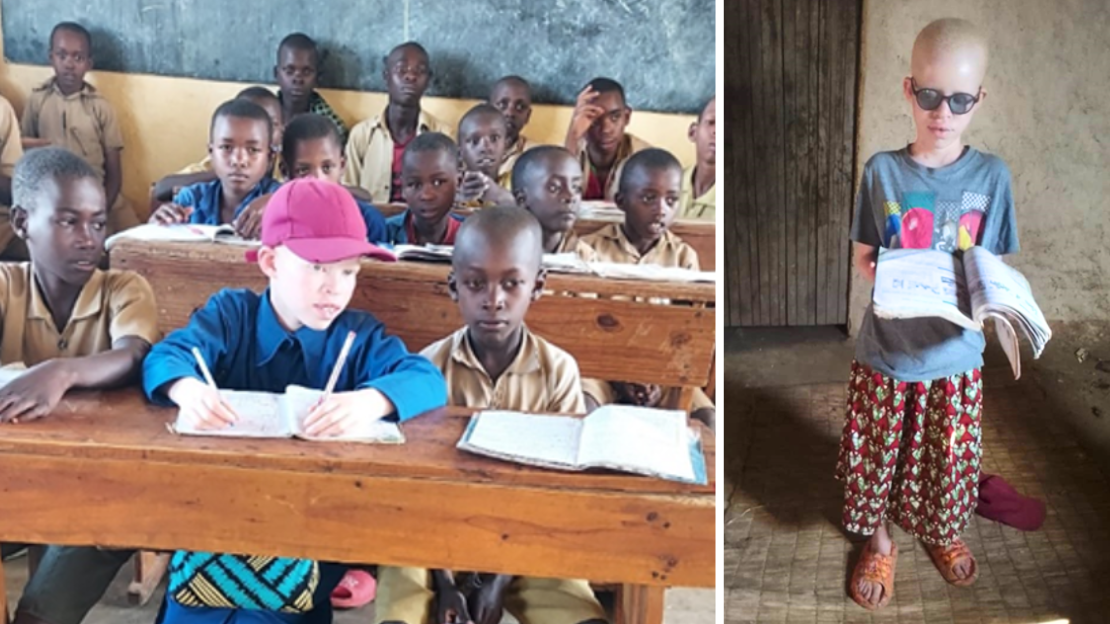 Sifa is a 13-year-old girl born with albinism.  